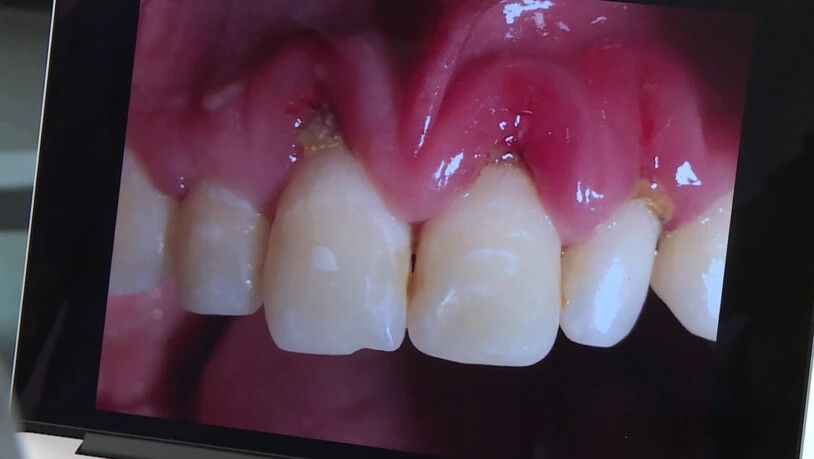 Unschöner Anblick für die Zahnärzte: Durch Snus verätzt sich das Zahnfleisch und es kommt zur Entzündung. Immer mehr solche Fälle sind bekannt.